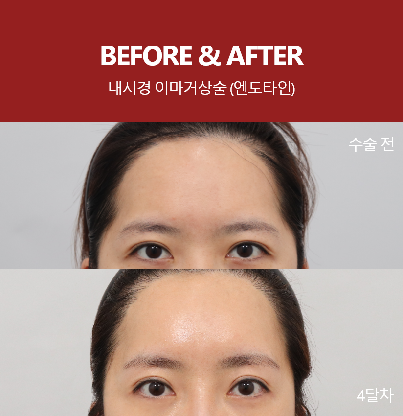before - after1개월