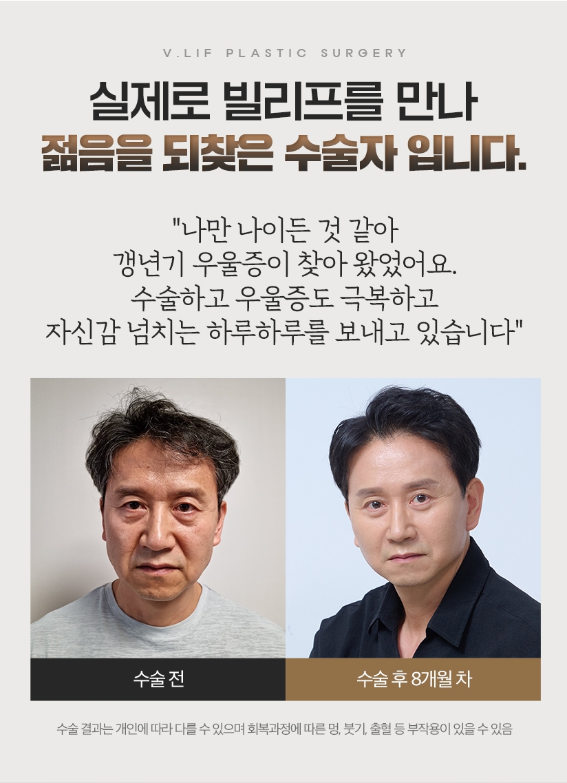 실제로 빌리프를 만나 젊음을 되찾은 수술자 입니다. 나만 나이든 것 같아 갱년기 우울증이 찾아 왔었어요. 수술하고 우울증도 극복하고 자신감 넘치는 하루하루를 보내고 있습니다. 수술 전 - 수술 후 8개월 차
