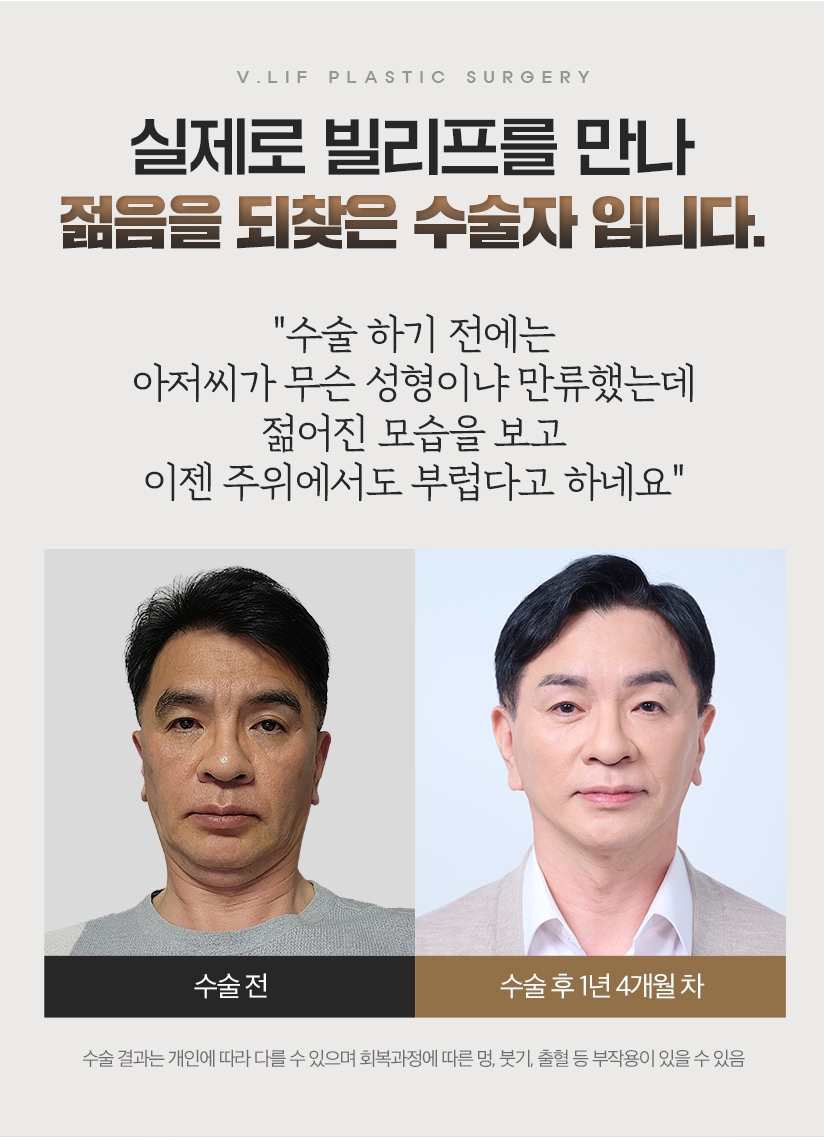 실제로 빌리프를 만나 젊음을 되찾은 수술자 입니다. 수술 하기 전에는 아저씨가 무슨 성형이냐 만류했는데 젊어진 모습을 보고 이젠 주위에서도 부럽다고 하네요. 수술 전 - 수술 후 1년 4개월 차 