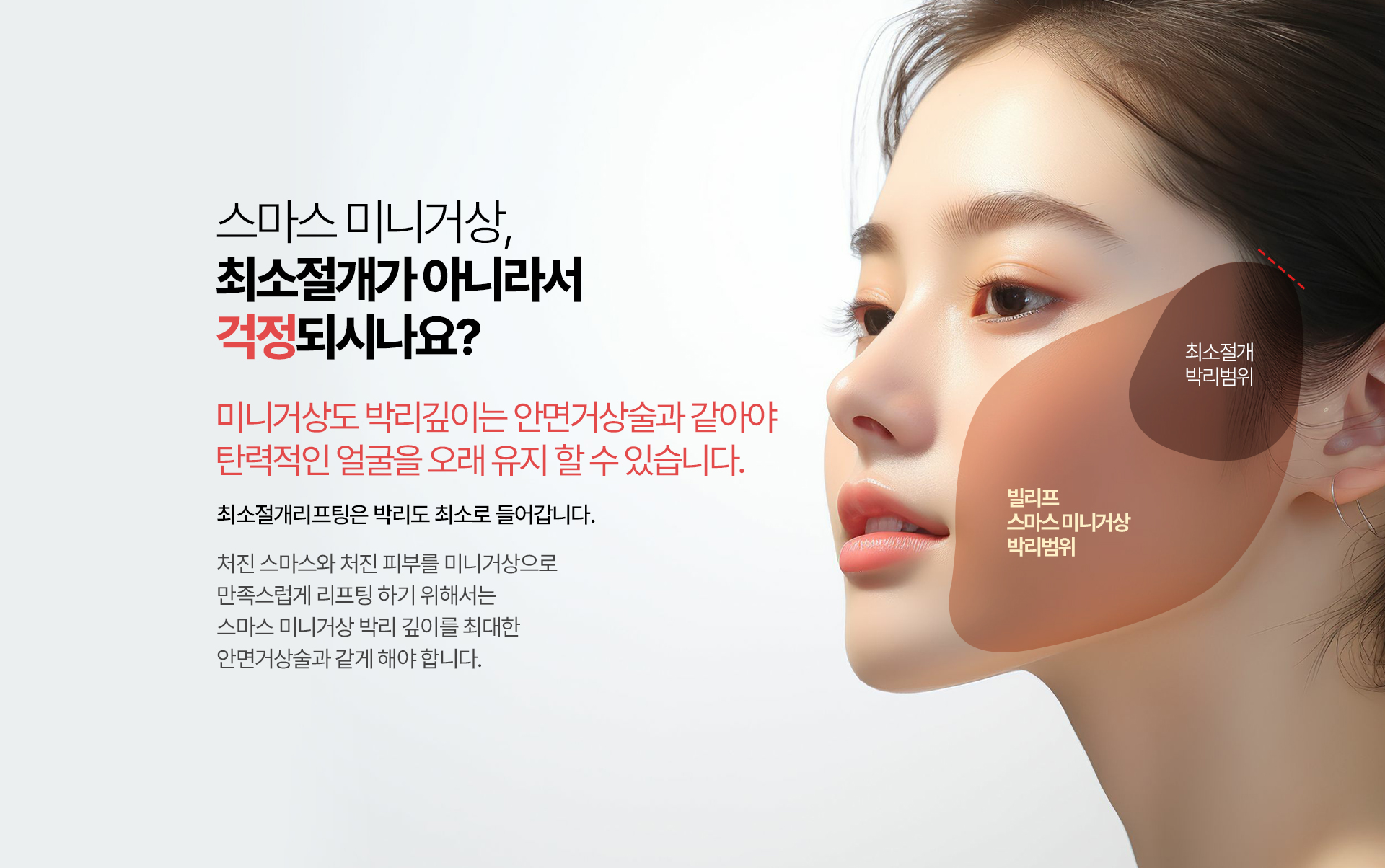 스마스 미니거상, 최소절개가 아니라서 걱정되시나요? 최소절개리프팅은  박리도 최소로 들어갑니다 처진 스마스와 처진 피부를 미니거상으로 만족스럽게 리프팅 하기 위해서는 스마스 미니거상 박리 깊이를 최대한 안면거상술과 같게 해야 오래 오래 탄력적인 얼굴을 유지 할 수 있습니다.