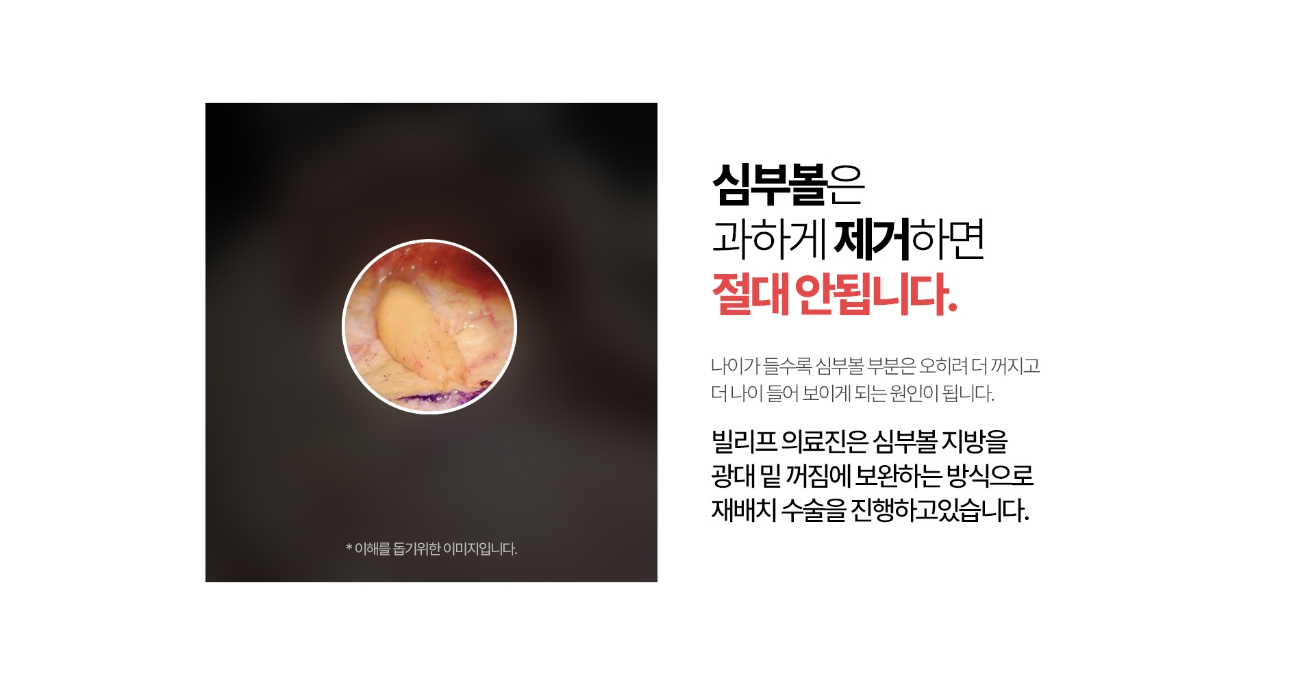 심부볼은 완전히 제거하면 절대 안됩니다. 나이가 들수록 심부볼 부분은 오히려 더 꺼지고 더 나이 들어 보이게 되는 원인이 됩니다. 빌리프 의료진은 심부볼 지방을 광대 밑 꺼짐에 보완하는 방식으로 재배치 수술을 진행하고있습니다.