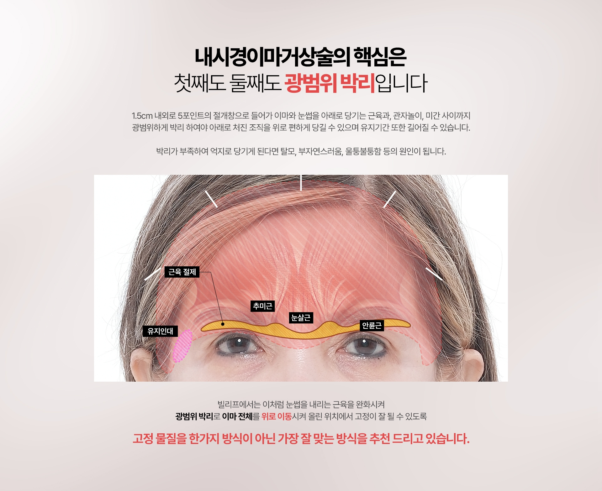 내시경이마거상술의 핵심은 첫째도 둘째도 광범위 박리입니다 1.5cm 내외로 5포인트의 절개창으로 들어가 이마와 눈썹을 아래로 당기는 근육과, 관자놀이, 미간 사이까지 광범위하게 박리 하여야 아래로 처진 조직을 위로 편하게 당길 수 있으며 유지기간 또한 길어질 수 있습니다. 박리가 부족하여 억지로 당기게 된다면 탈모, 부자연스러움, 울퉁불퉁함 등의 원인이 됩니다. 빌리프에서는 이처럼 눈썹을 내리는 근육을 완화시켜 광범위 박리로 이마 전체를 위로 이동시켜 올린 위치에서 고정이 잘 될 수 있도록 고정 물질을 한가지 방식이 아닌 가장 잘 맞는 방식을 추천 드리고 있습니다.