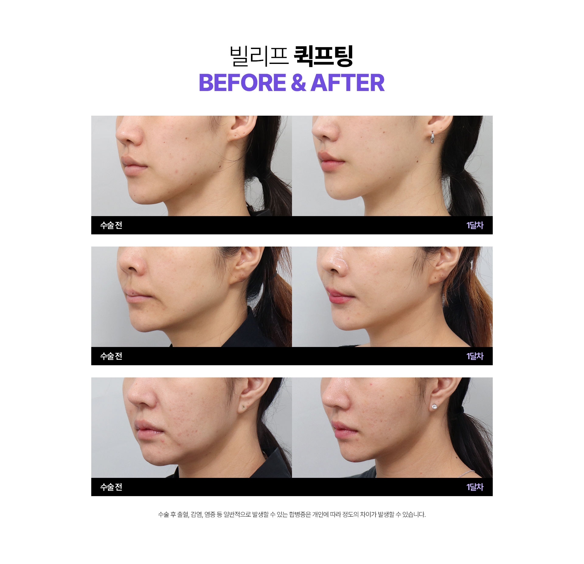 빌리프 퀵프팅 Before & After 수술전 - 1달차