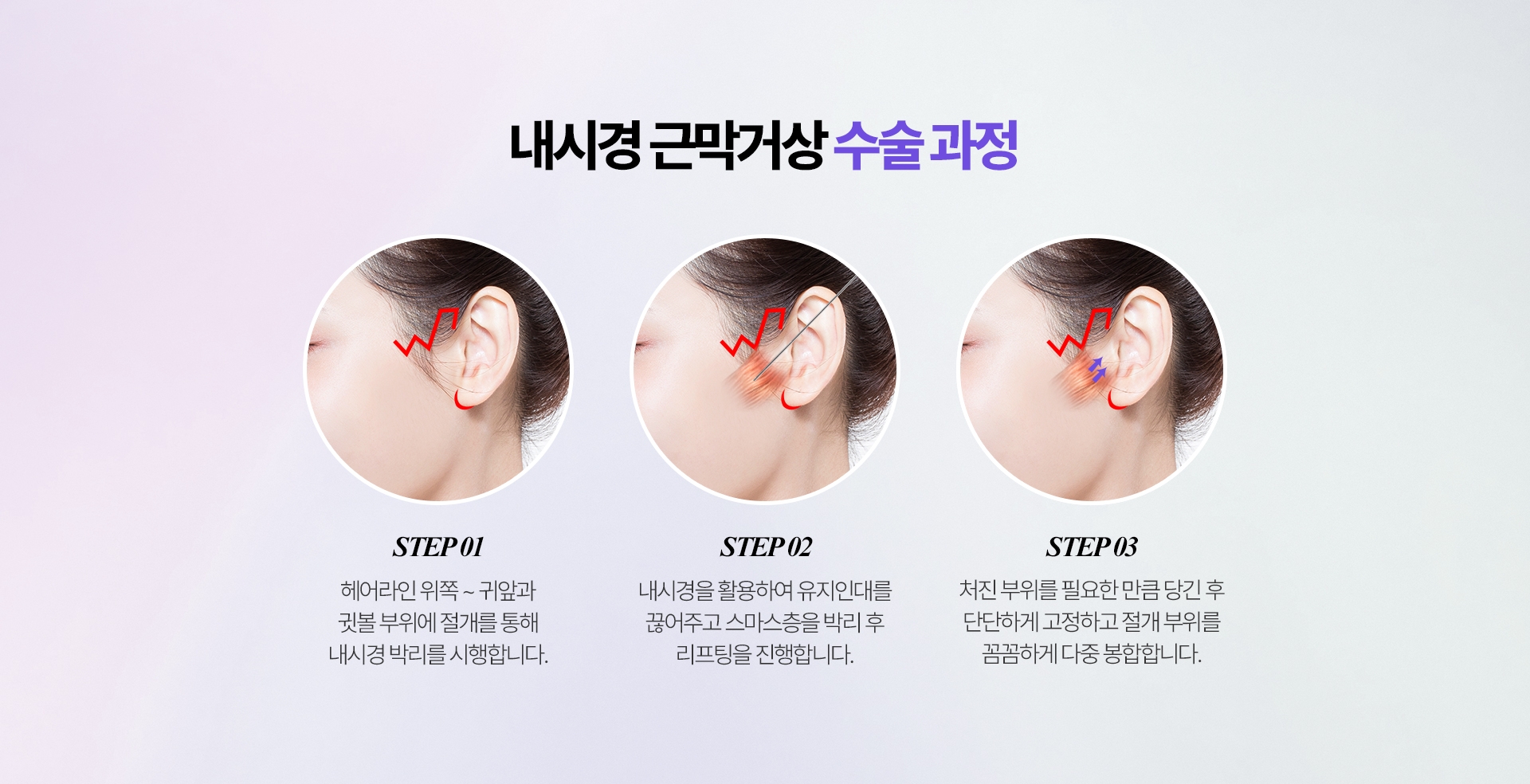 내시경 근막거상 수술 과정 STEP 1. 헤어라인 위쪽 ~ 귀앞과 귓볼 부위에 절개를 통해 내시경 박리를 시행합니다. STEP 2. 내시경을 활용하여 유지인대를 끊어주고 스마스층을 박리 후 리프팅을 진행합니다. STEP 3. 처진 부위를 필요한 만큼 당긴 후 단단하게 고정하고 절개 부위를  꼼꼼하게 다중 봉합합니다.