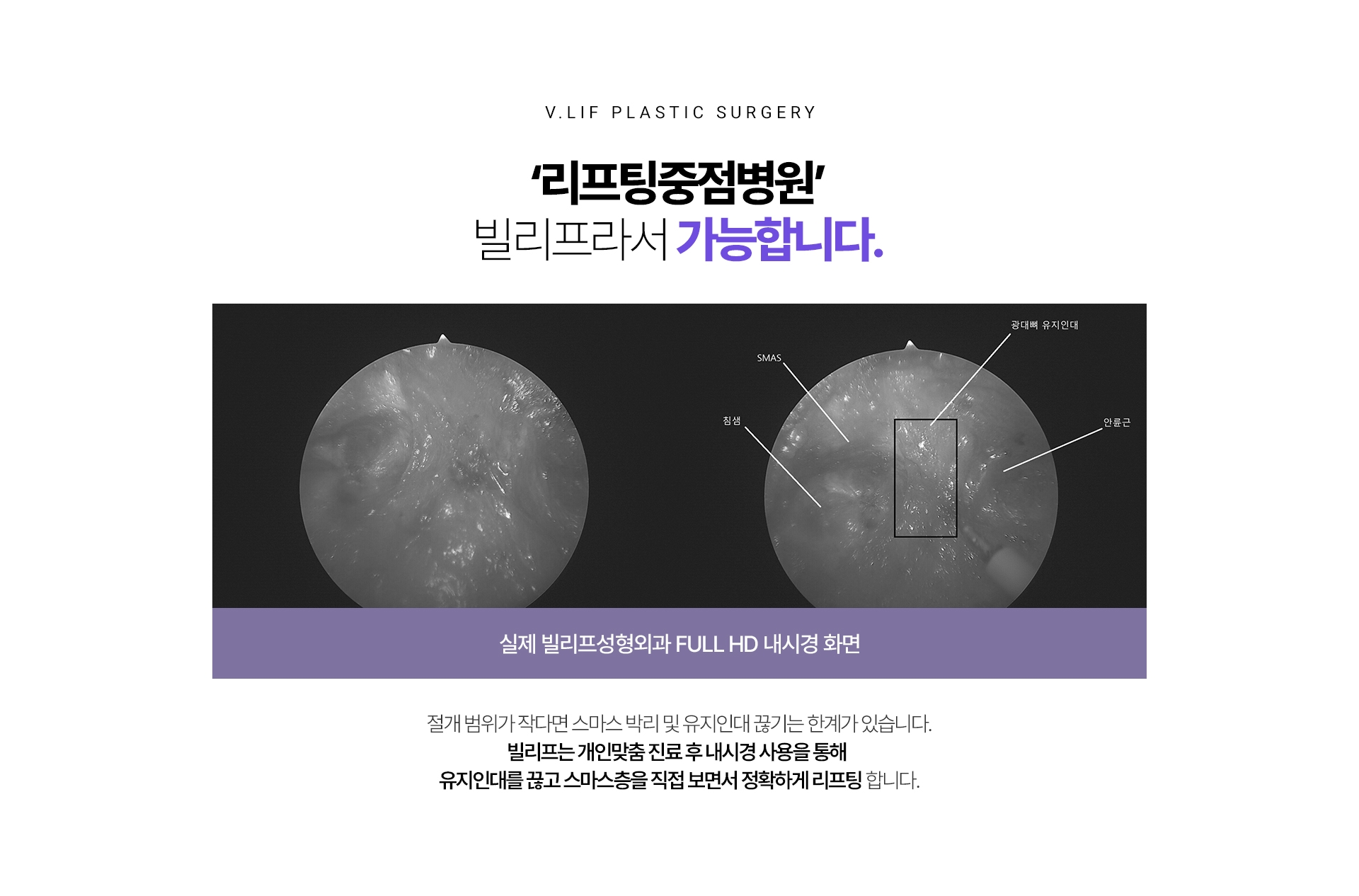 ‘리프팅중점병원’ 빌리프라서 가능합니다. 절개 범위가 작다면 스마스 박리 및 유지인대 끊기는 한계가 있습니다. 빌리프는 개인맞춤 진료 후 내시경 사용을 통해 유지인대를 끊고 스마스층을 직접 보면서 정확하게 리프팅 합니다.