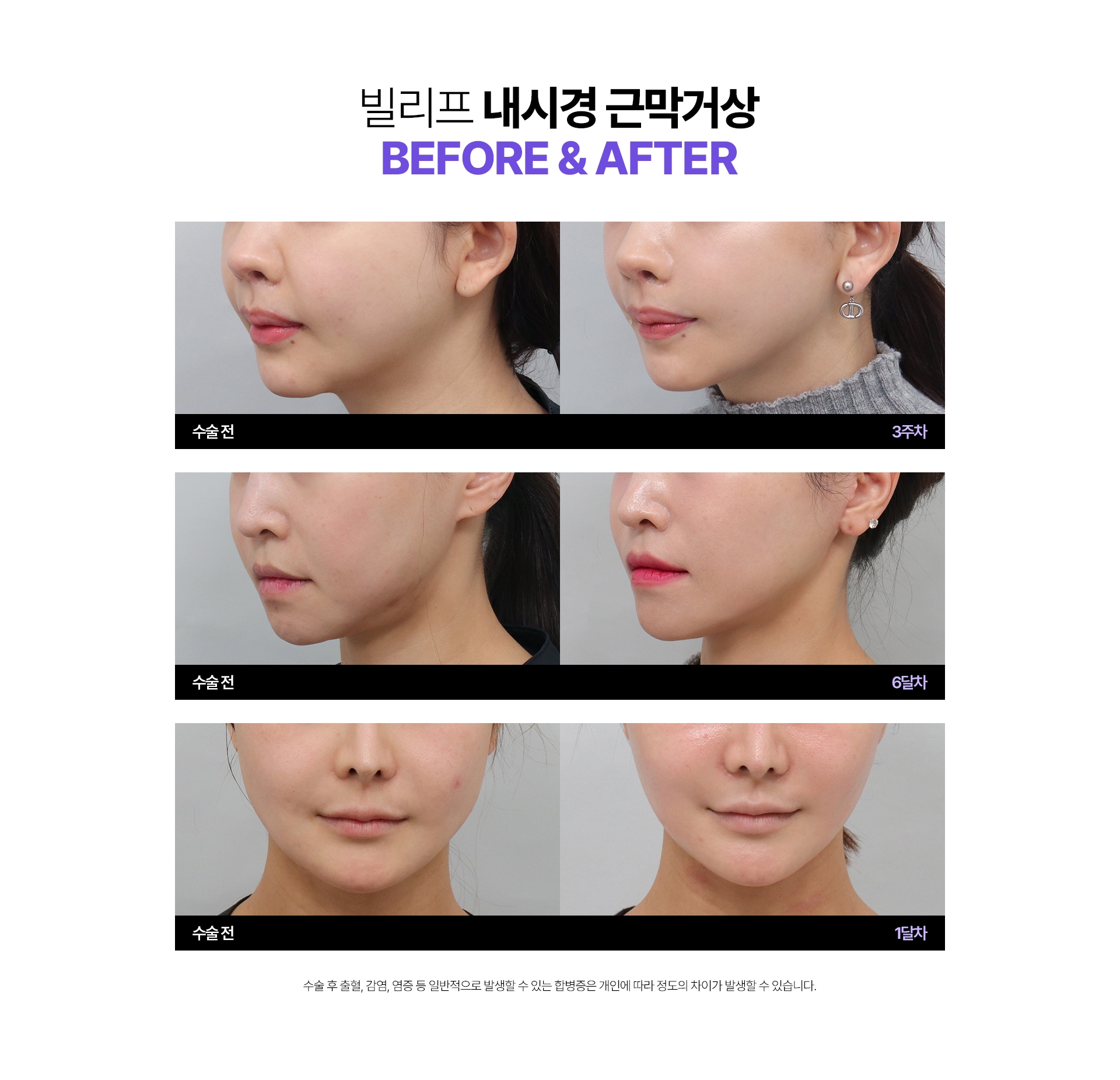 빌리프 내시경 근막거상Before & After 수술전 - 3주차, 수술전 - 6달차, 수술전 - 1달차 수술 후 출혈, 감염, 염증 등 일반적으로 발생할 수 있는 합병증은 개인에 따라 정도의 차이가 발생할 수 있습니다.