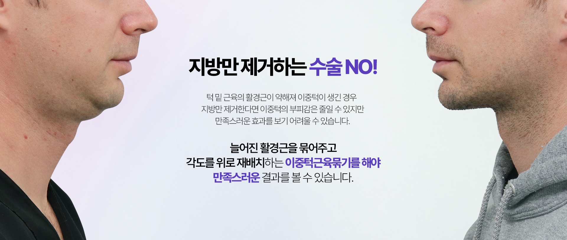 지방만 제거하는 수술 NO! 턱 밑 근육의 활경근이 약해져 이중턱이 생긴 경우 지방만 제거한다면 이중턱의 부피감은 줄일 수 있지만 만족스러운 효과를 보기 어려울 수 있습니다.늘어진 활경근을 묶어주고 각도를 위로 재배치하는 이중턱근육묶기를 해야 만족스러운 결과를 볼 수 있습니다.