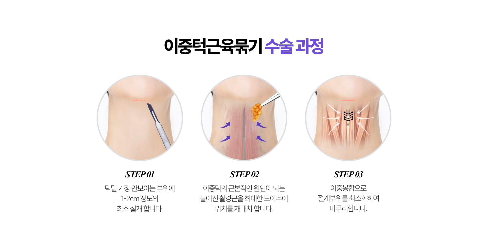 빌리프 이중턱근육묶기 수술과정 STEP 1. 턱밑 가장 안보이는 부위에 1-2cm 정도의 최소 절개 합니다./ STEP 2. 이중턱의 근본적인 원인이 되는 늘어진 활경근을 최대한 모아주어 위치를 재배치 합니다. / STEP 3. 이중봉합으로 절개부위를최소화하여 마무리합니다. 