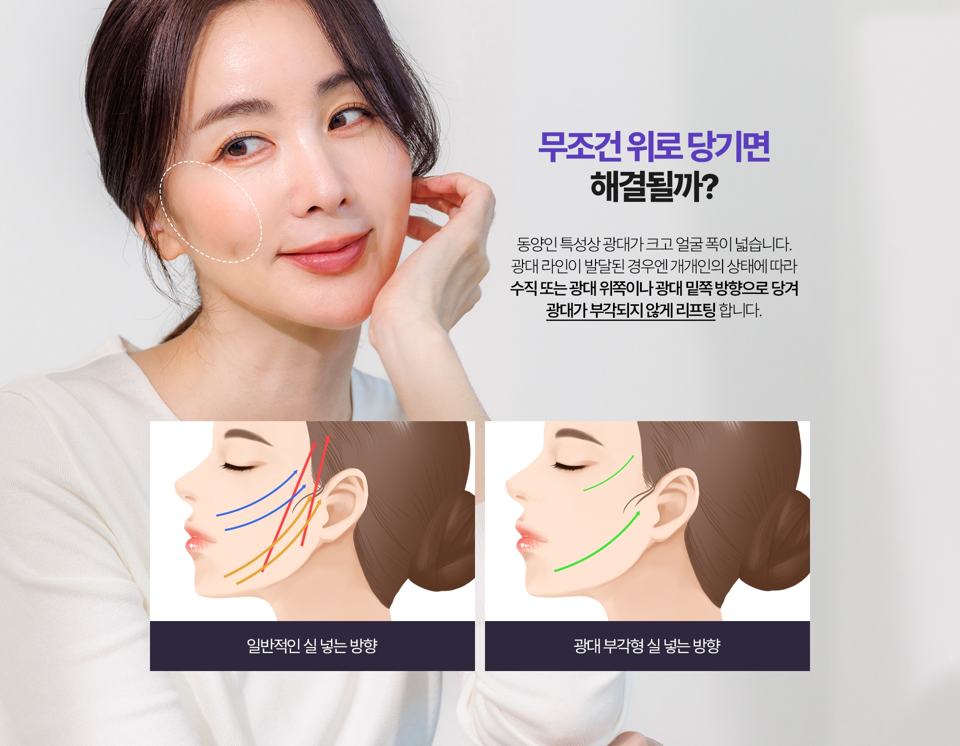 무조건 위로 당기면 해결될까? 동양인 특성상 광대가 크고 얼굴 폭이 넓습니다. 광대 라인이 발달된 경우엔 개개인의 상태에 따라 수직 또는 광대 위쪽이나 광대 밑쪽 방향으로 당겨 광대가 부각되지 않게 리프팅 합니다.