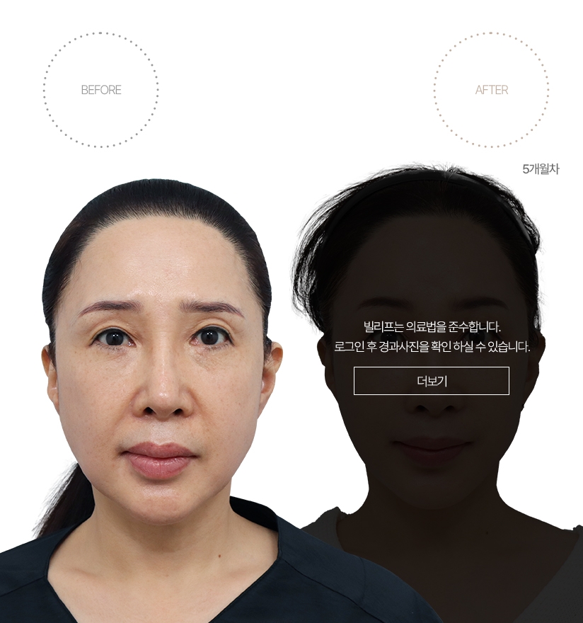 5개월차 BEFORE - AFTER