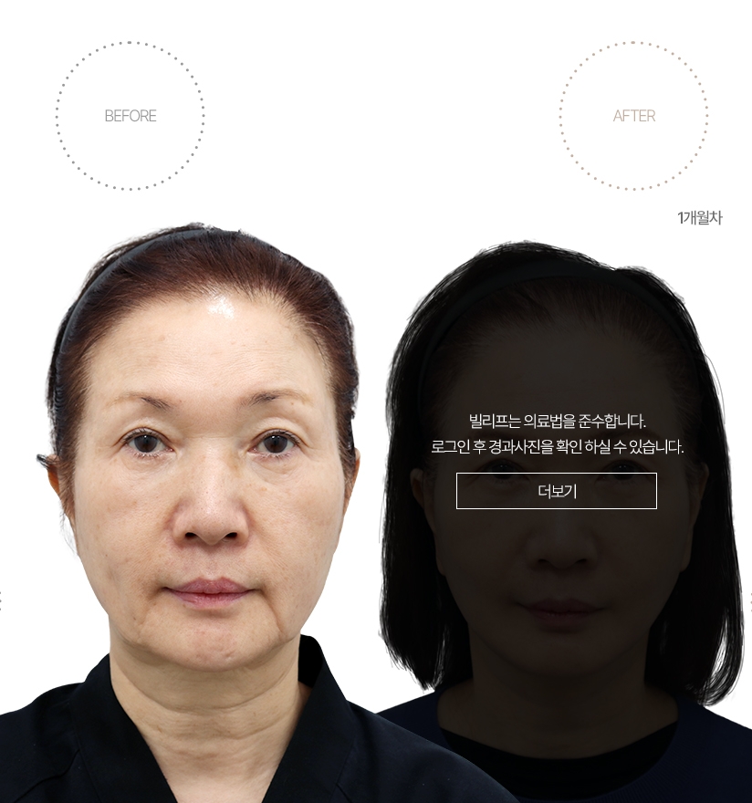 5개월차 BEFORE - AFTER