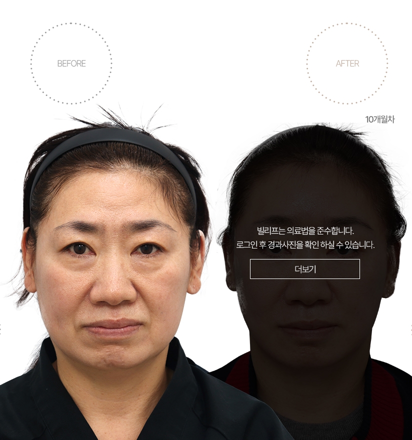 5개월차 BEFORE - AFTER