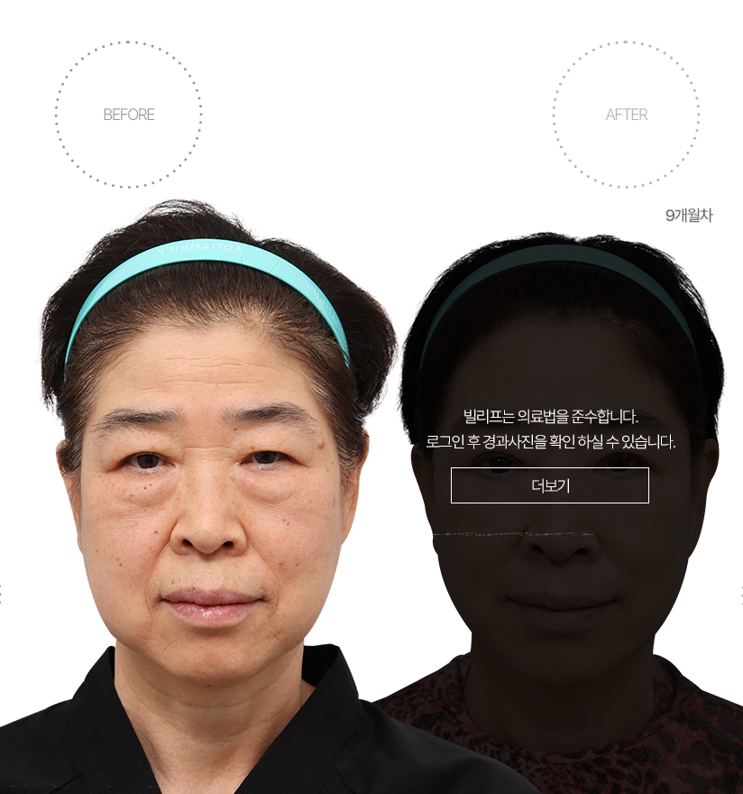 5개월차 BEFORE - AFTER