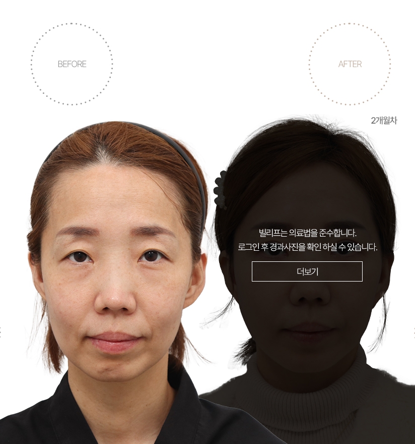 5개월차 BEFORE - AFTER