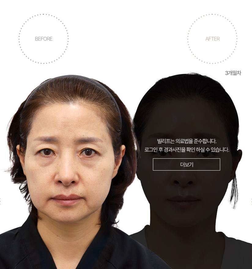 5개월차 BEFORE - AFTER