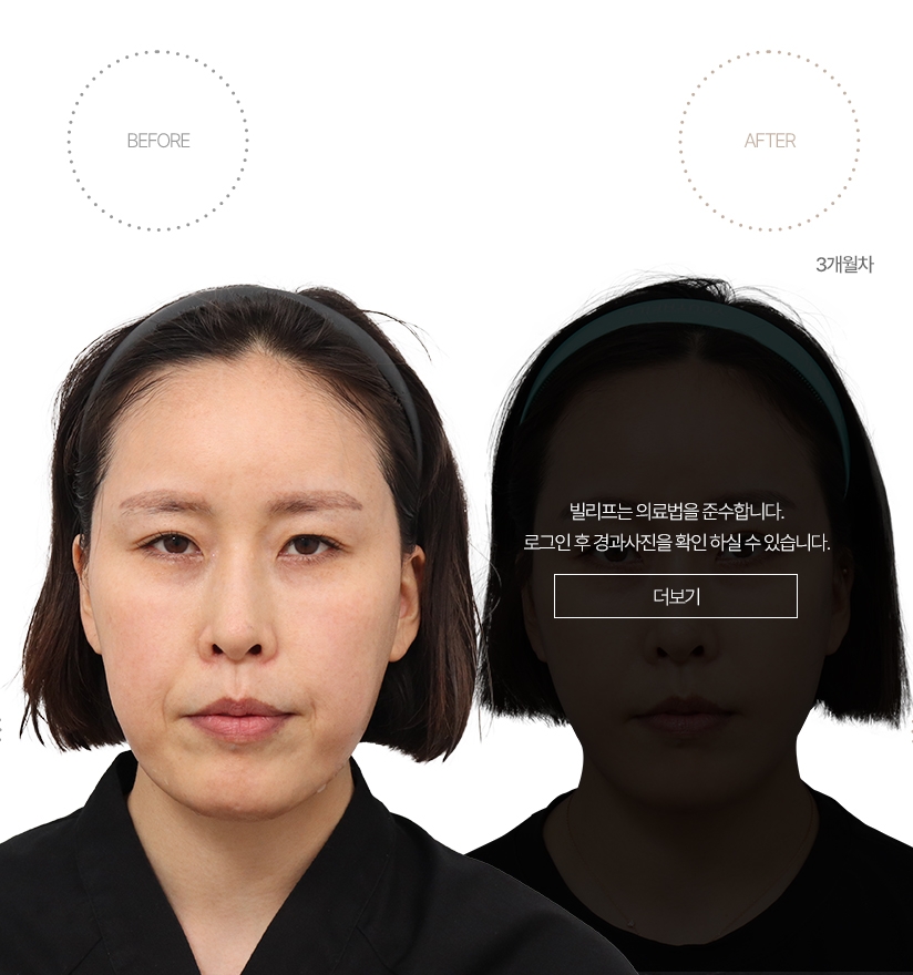 5개월차 BEFORE - AFTER