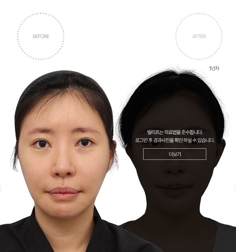 5개월차 BEFORE - AFTER