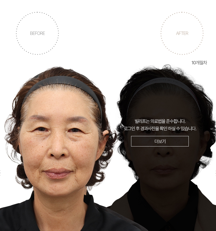 5개월차 BEFORE - AFTER