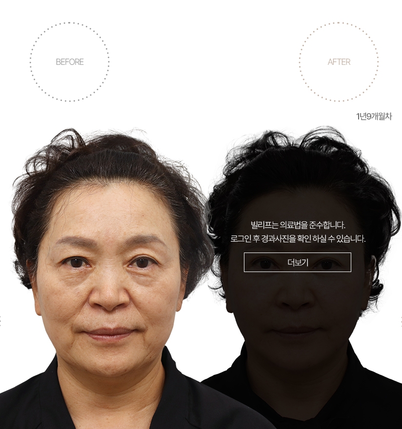 5개월차 BEFORE - AFTER