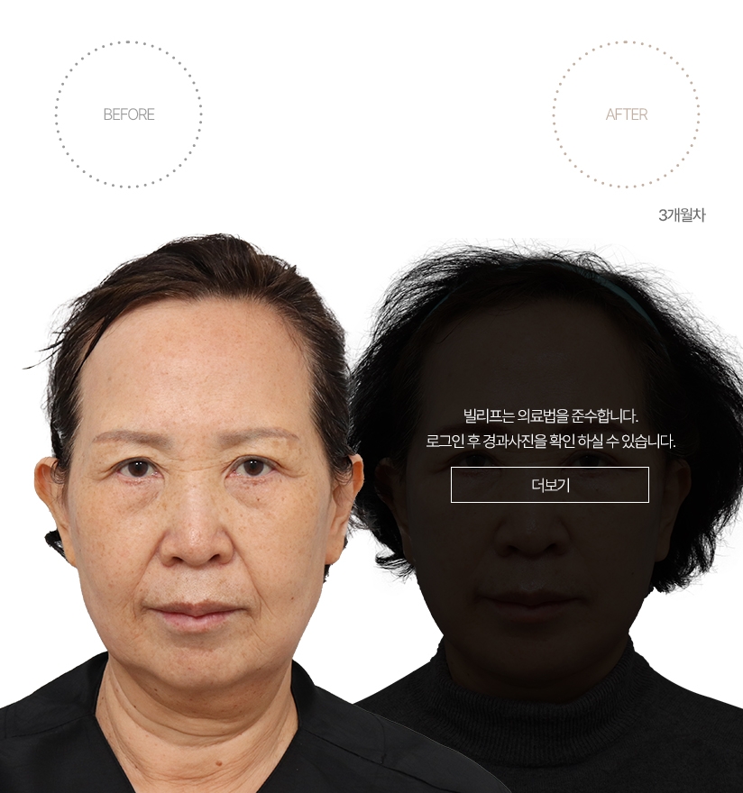 5개월차 BEFORE - AFTER