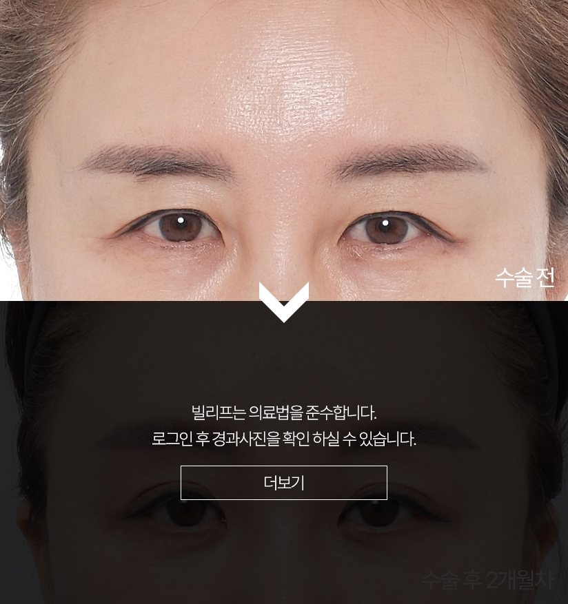 수술 전 - 수술 후 2개월차