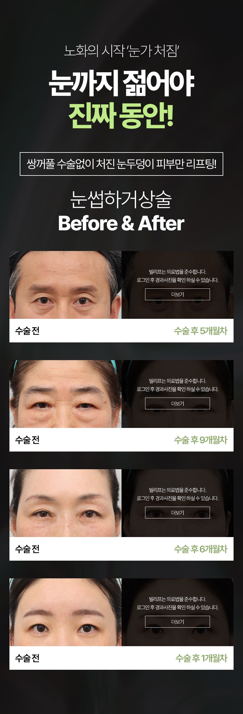 노화의 시작 ‘눈가 처짐‘ 눈까지 젊어야 진짜 동안! 쌍꺼풀 수술없이 처진 눈두덩이 피부만 리프팅! 눈썹하거상술