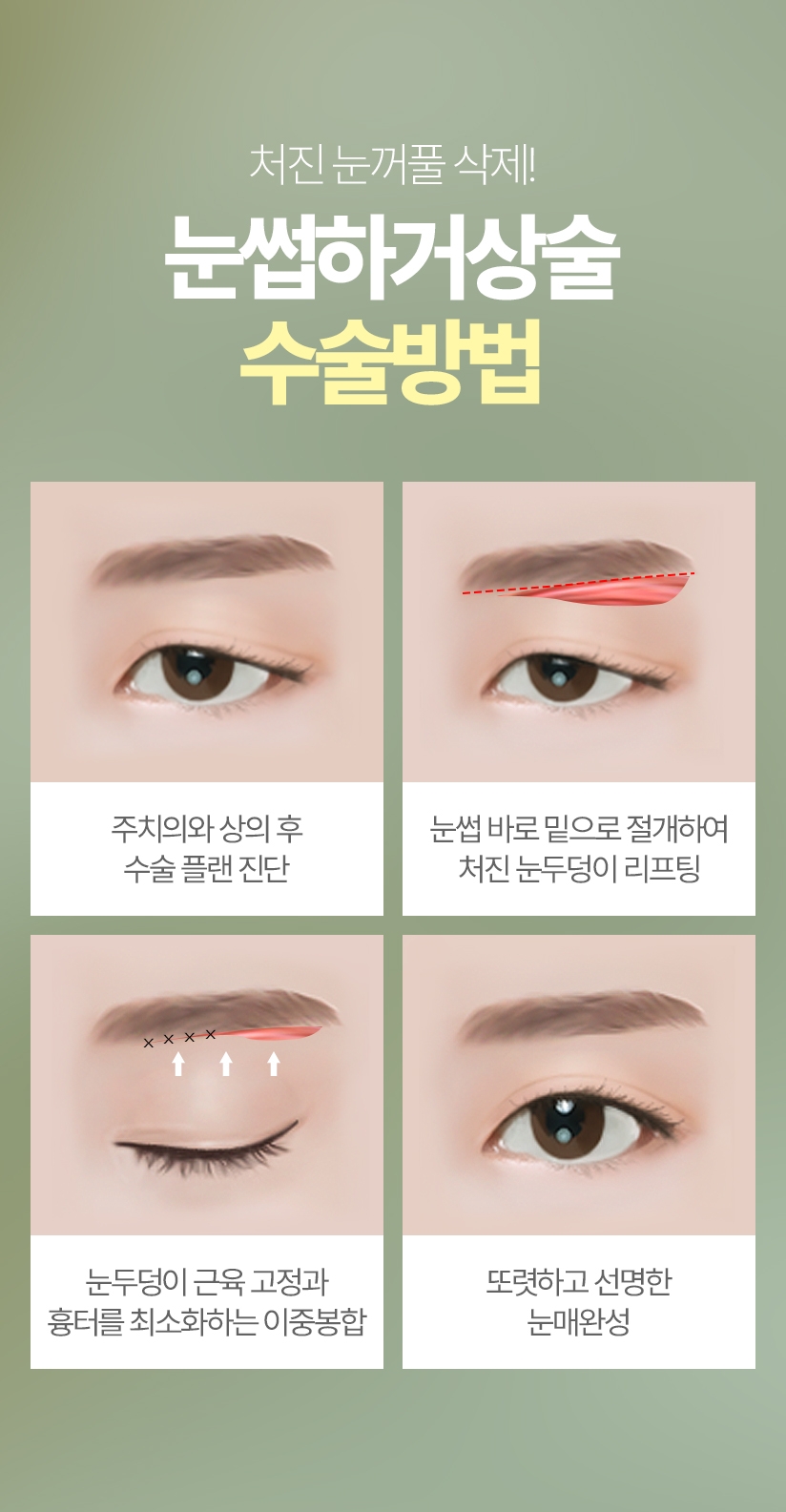 처진 눈꺼풀 삭제! 눈썹하거상술 수술방법 01 주치의와 상의 후 수술 플랜 진단, 02 눈썹 바로 밑으로 절개하여 처진 눈두덩이 리프팅, 03 눈두덩이 근육 고정과흉터를 최소화하는 이중봉합, 04 또렷하고 선명한 눈매완성