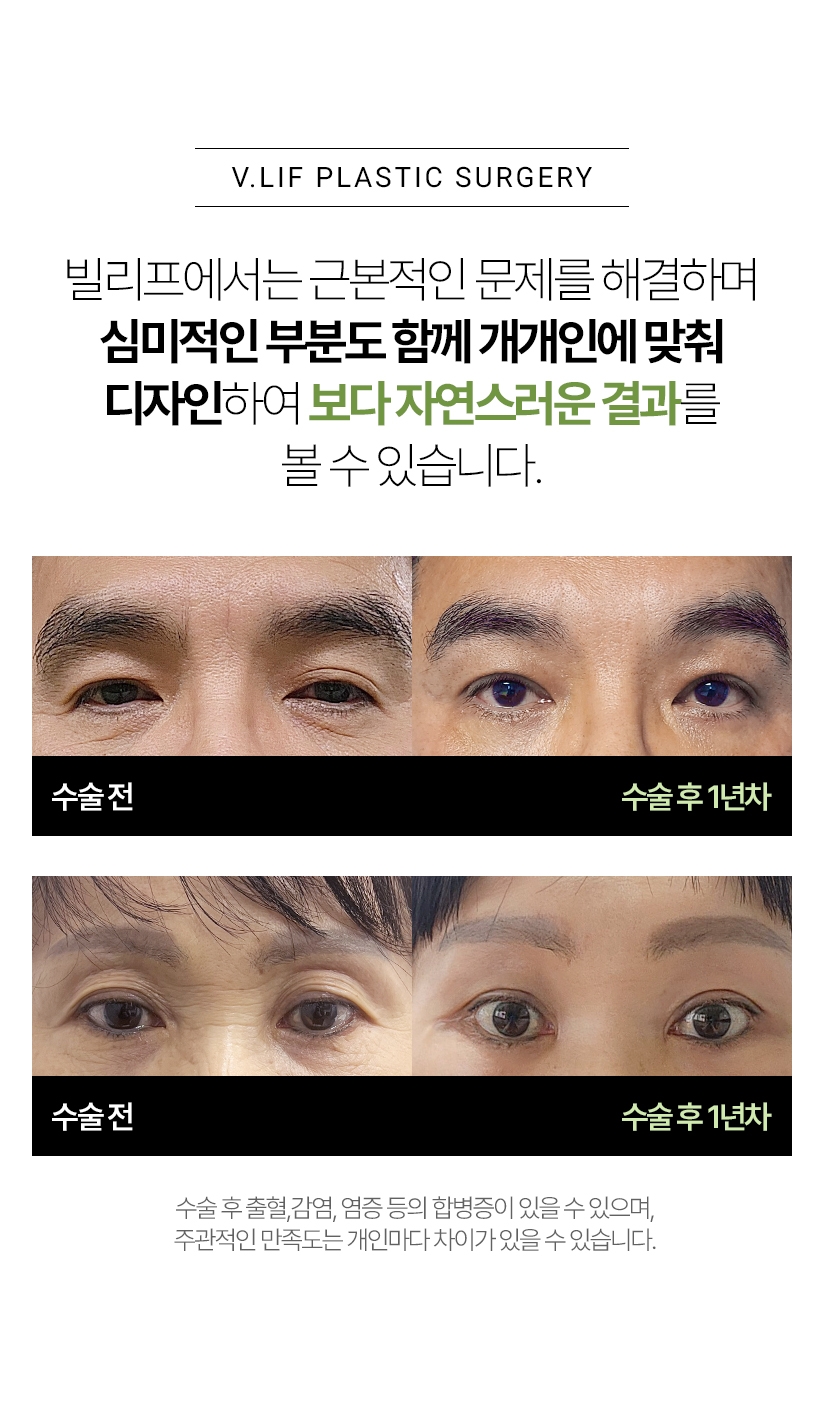 빌리프에서는 근본적인 문제를 해결하며 심미적인 부분도 함께 개개인에 맞춰 디자인하여 보다 자연스러운 결과를 볼 수 있습니다. 수술 전 - 수술 후 1년차 *수술 후 출혈,감염,염증 등의 합병증이 있을 수 있으며 주관적인 만족도는 개인마다 차이가 있을 수 있습니다.