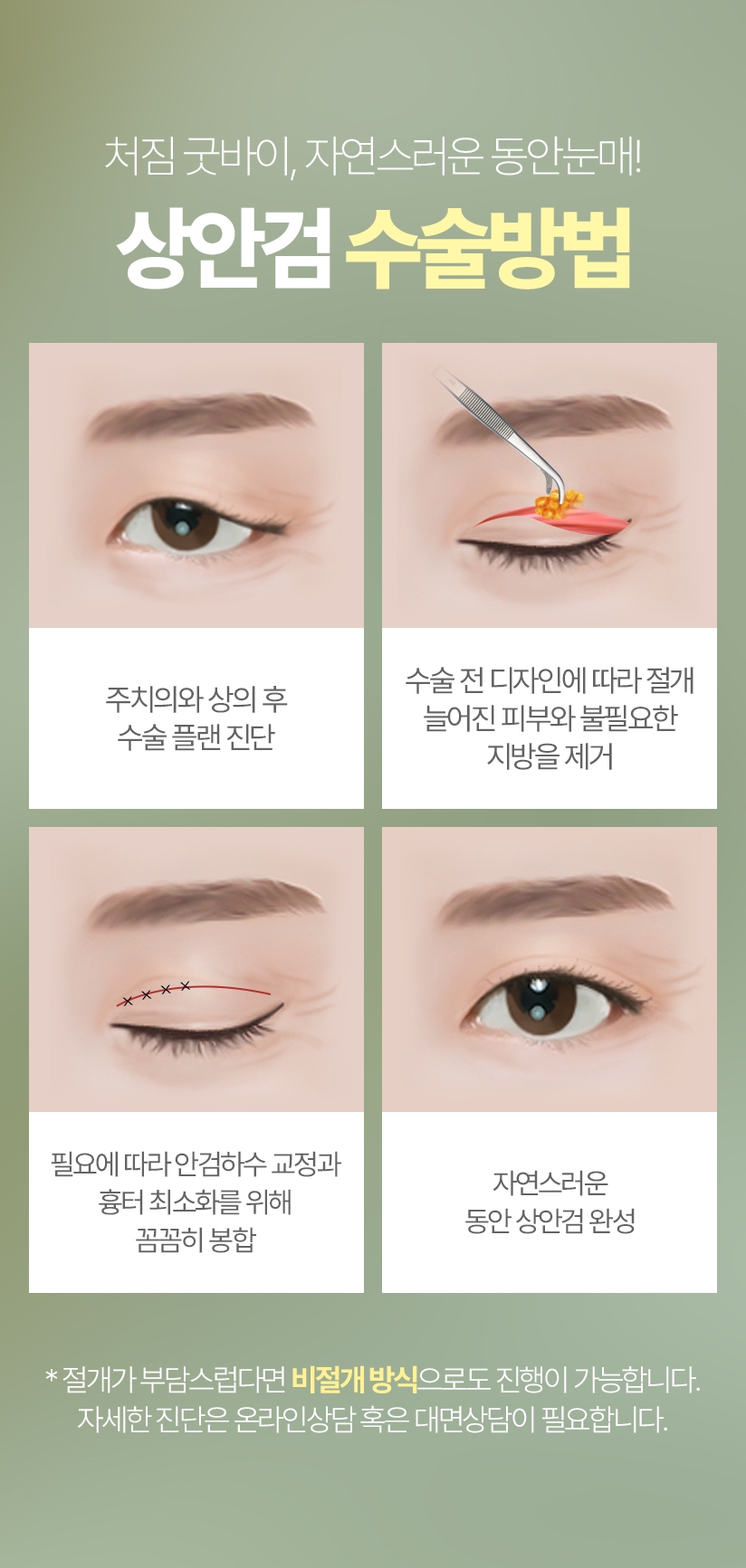 처짐 굿바이, 자연스러운 동안눈매! 상안검 수술방법 - 01 주치의와 상의 후 수술 플랜 진단 / 02 수술 전 디자인에 따라 절개, 늘어진 피부와 불필요한 지방을 제거 / 03 필요에 따라 안검하수 교정과 흉터를 최소화하며 꼼꼼히 봉합 / 04 자연스러운 동안 상안검 완성 *절개가 부담스럽다면 비절개 방식으로도 진행이 가능합니다. 자세한 진단은 온라인상담 혹은 대면상담이 필요합니다.