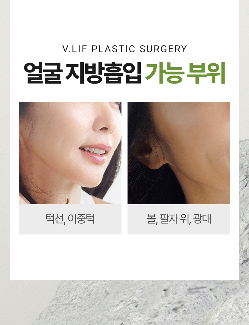 얼굴 지방흡입 가능 부위 턱선, 이중턱 볼, 팔자 위, 광대