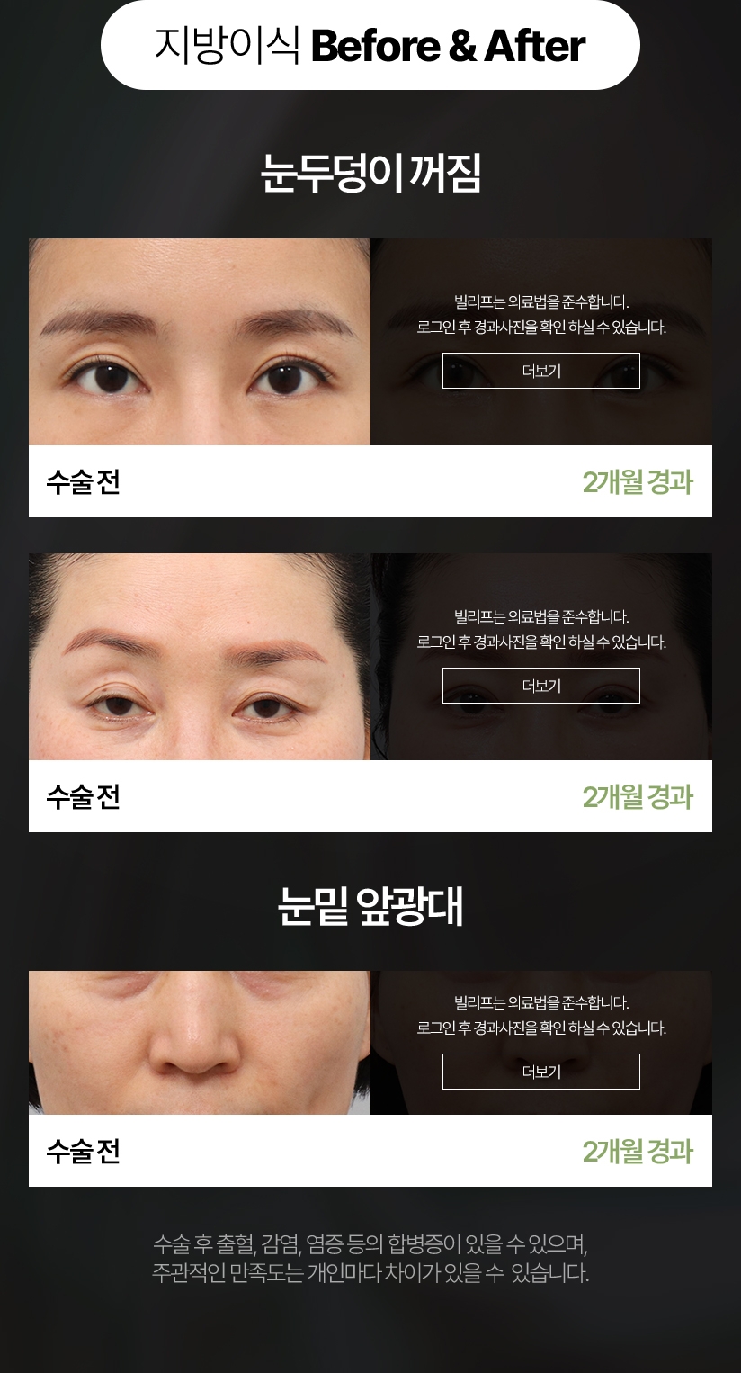지방이식 Before & After 눈두덩이 꺼짐 수술 전 - 2개월 경과