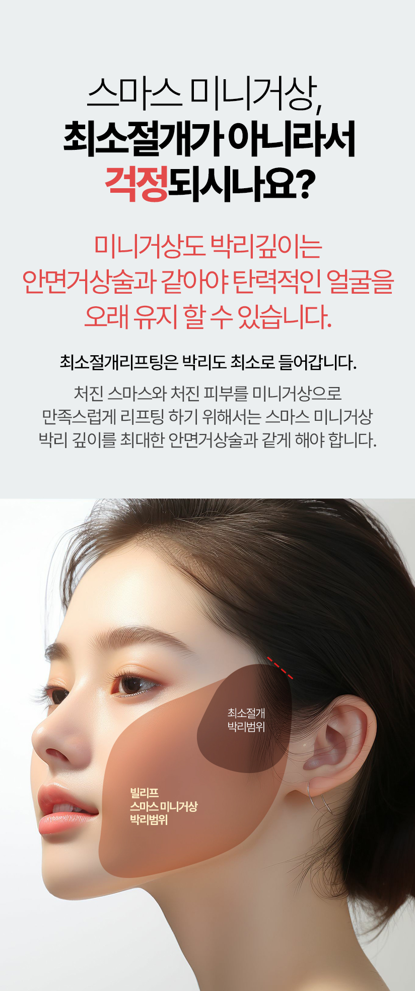 스마스 미니거상, 최소절개가 아니라서 걱정되시나요? 최소절개리프팅은  박리도 최소로 들어갑니다 처진 스마스와 처진 피부를 미니거상으로 만족스럽게 리프팅 하기 위해서는 스마스 미니거상 박리 깊이를 최대한 안면거상술과 같게 해야 오래 오래 탄력적인 얼굴을 유지 할 수 있습니다.