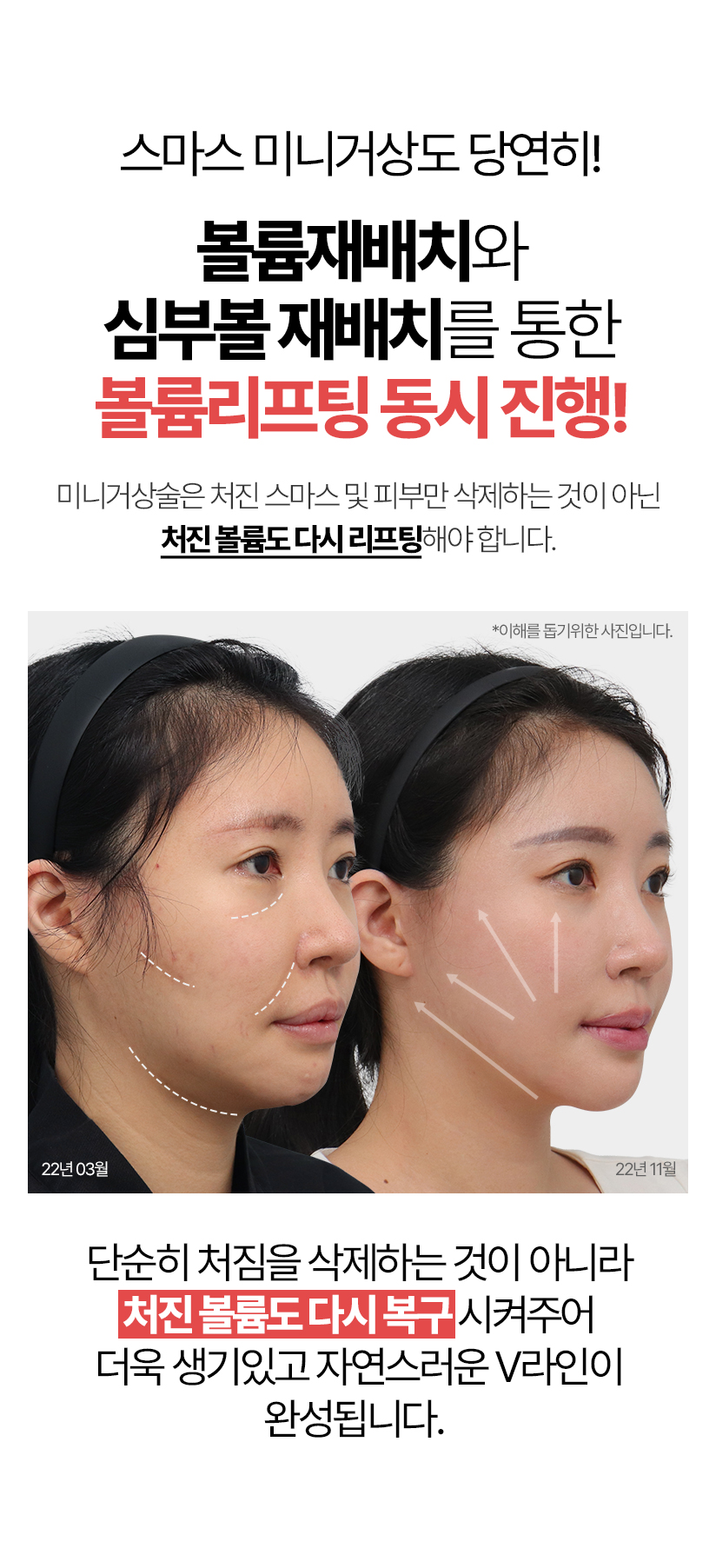 스마스 미니거상도 당연히! 볼륨재배치와 심부볼 재배치를 통한 볼륨리프팅 동시 진행! 안면거상술은 처진 스마스 및 피부만 삭제하는 것이 아닌 처진 볼륨도 다시 리프팅해야 합니다. 단순히 처짐을 삭제하는 것이 아니라 처진 볼륨도 다시 복구시켜주어 더욱 생기있고 자연스러운 V라인이 완성됩니다.