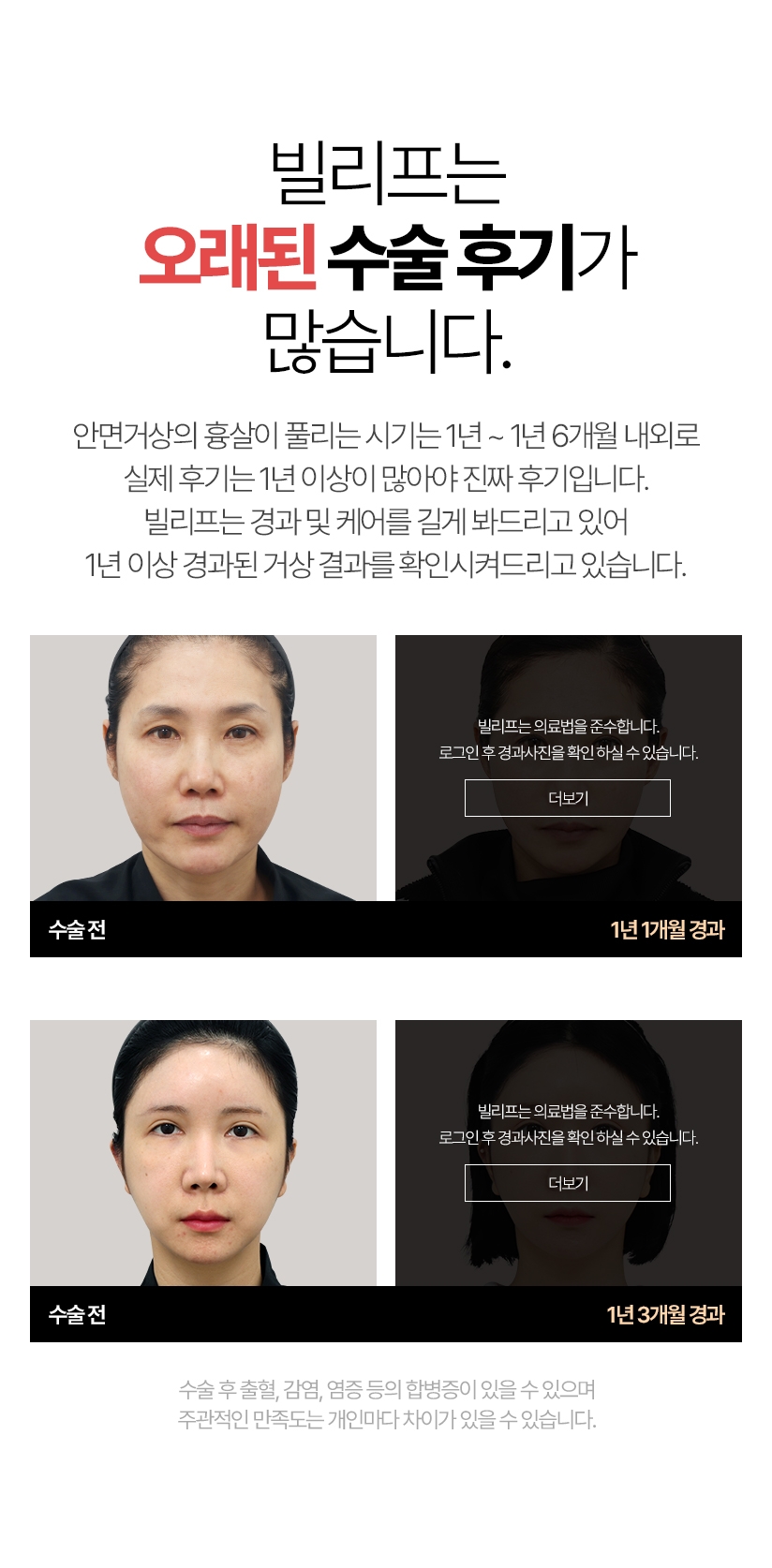 빌리프는 오래된 수술 후기가 많습니다. 스마스미니거상의 흉살이 풀리는 시기는 1년~ 1년 6개월 내외로실제 후기는 1년 이상이 많아야 진짜 후기입니다 빌리프는 경과 및 케어를 길게 봐드리고 있어 1년 이상 경과된 거상 결과를 확인시켜드리고 있습니다.