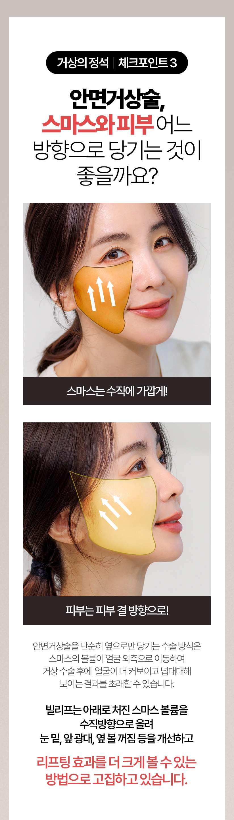 거상의 정석 체크포인트 3 - 안면거상술, 스마스와 피부 어느 방향으로 당기는 것이 좋을까요? 안면거상술을 단순히 옆으로만 당기는 수술 방식은 스마스의 볼륨이 얼굴 외측으로 이동하여 거상 수술 후에 얼굴이 더 커보이고 넙대대해 보이는 결과를 초래할 수 있습니다. 빌리프는 아래로 처진 스마스 볼륨을 수직방향으로 올려 눈 밑, 앞 광대, 옆 볼 꺼짐 등을 개선하고 리프팅 효과를 더 크게 볼 수 있는 방법으로 고집하고 있습니다.