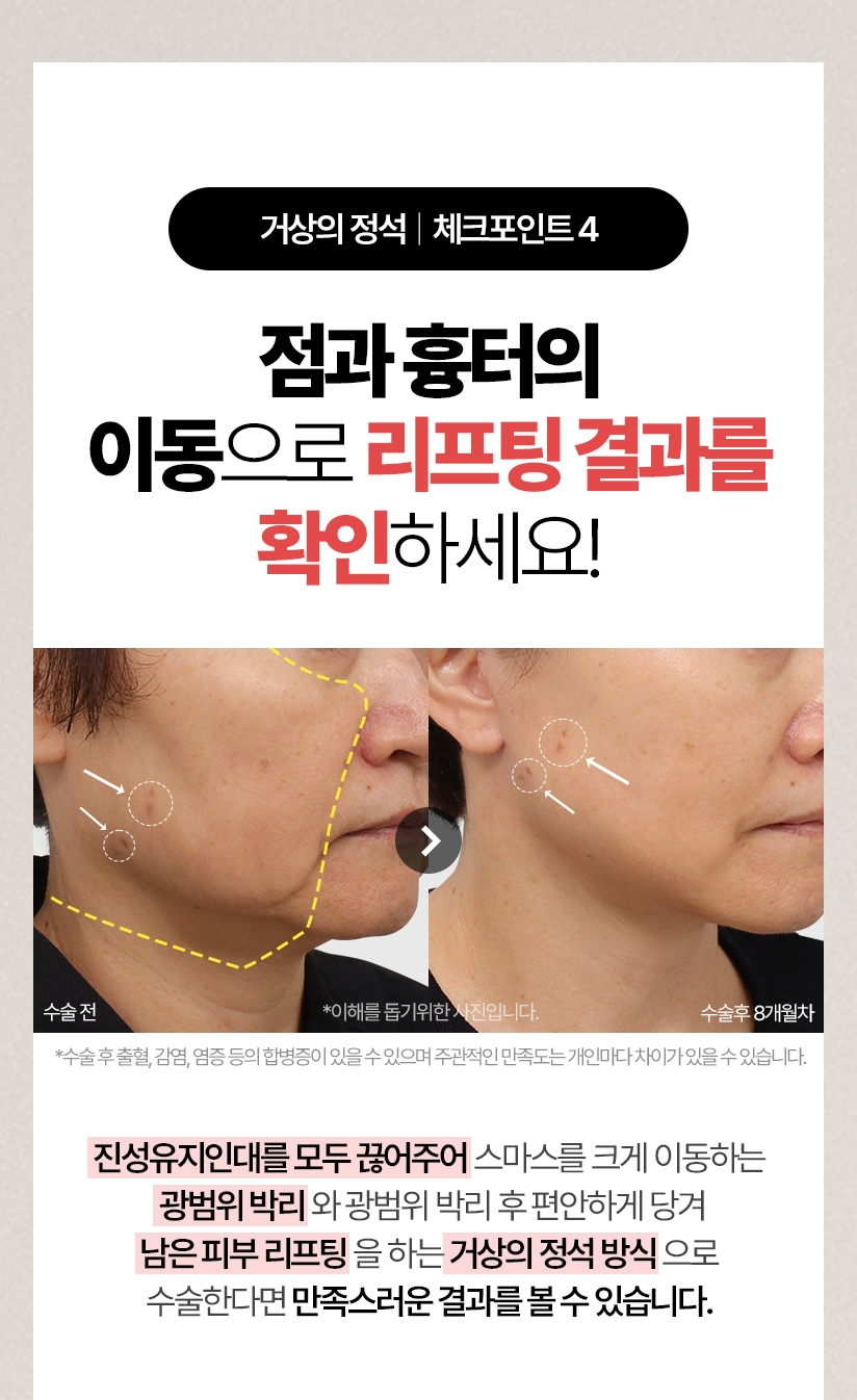 거상의 정석 체크포인트 4 - 점과 흉터의 이동으로 리프팅 결과를 확인하세요! 진성유지인대를 모두 끊어주어  스마스를 크게 이동하는  광범위 박리와 광범위 박리 후 편안하게 당겨 남은 피부 리프팅을 하는 거상의 정석 방식으로 수술한다면 만족스러운 결과를 볼 수 있습니다.