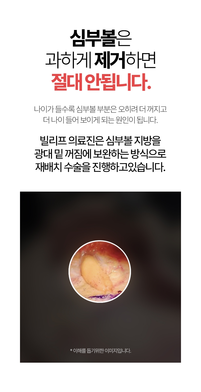 심부볼은 완전히 제거하면 절대 안됩니다. 나이가 들수록 심부볼 부분은 오히려 더 꺼지고 더 나이 들어 보이게 되는 원인이 됩니다. 빌리프 의료진은 심부볼 지방을 광대 밑 꺼짐에 보완하는 방식으로 재배치 수술을 진행하고있습니다.