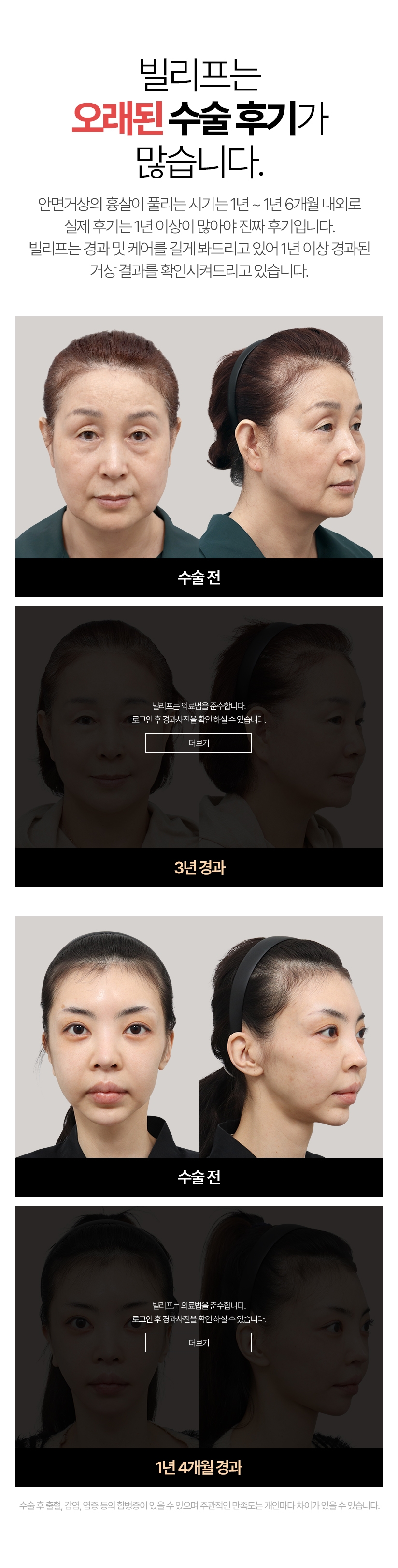 빌리프는 오래된 수술 후기가 많습니다. 안면거상의 흉살이 풀리는 시기는 1년~ 1년 6개월 내외로실제 후기는 1년 이상이 많아야 진짜 후기입니다 빌리프는 경과 및 케어를 길게 봐드리고 있어 1년 이상 경과된 거상 결과를 확인시켜드리고 있습니다. 수술 후 출혈, 감염, 염증 등의 합병증이 있을 수 있으며 주관적인 만족도는 개인마다 차이가 있을 수 있습니다.