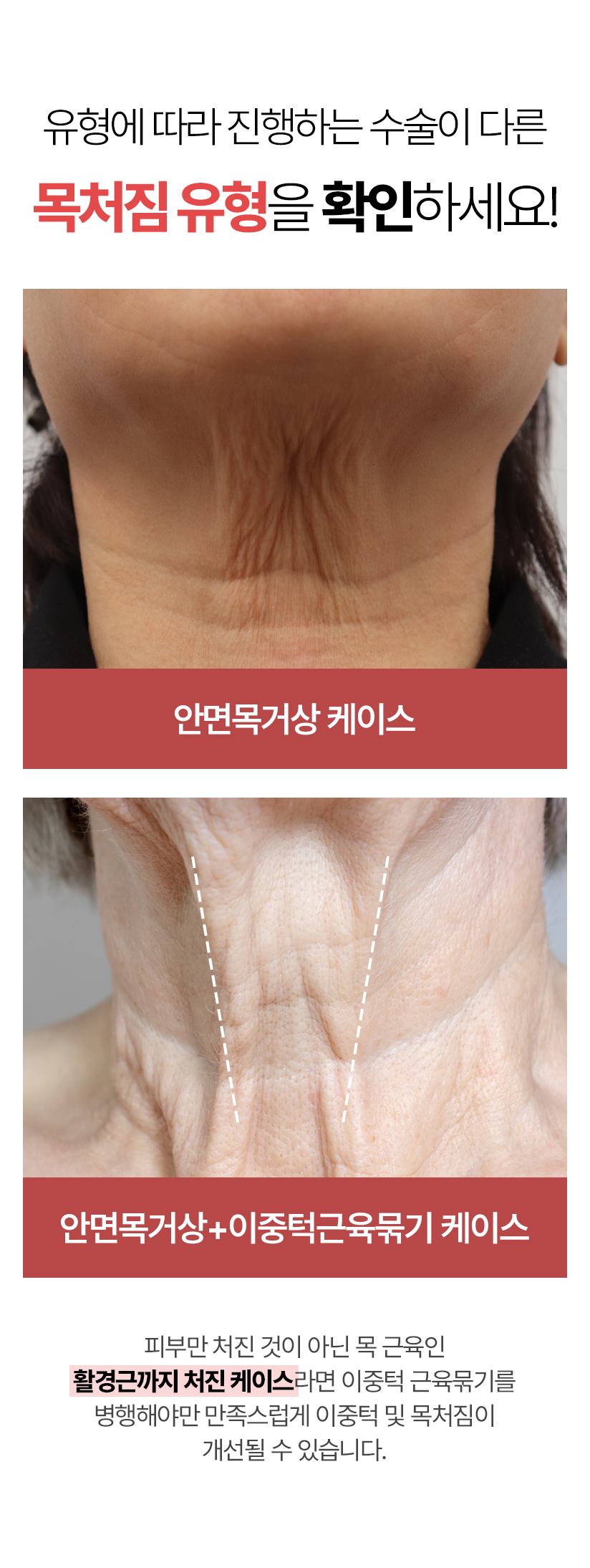 유형에 따라 진행하는 수술이 다른 목처짐 유형을 확인하세요! 안면목거상 케이스, 안면목거상+이중턱근육묶기 케이스 (피부만 처진 것이 아닌 목 근유인 활경근까지 처진 케이스라면 이중턱 근육묶기를 병행해야만 만족스럽게 이중턱 및 목처짐이 개선될 수 있습니다.)