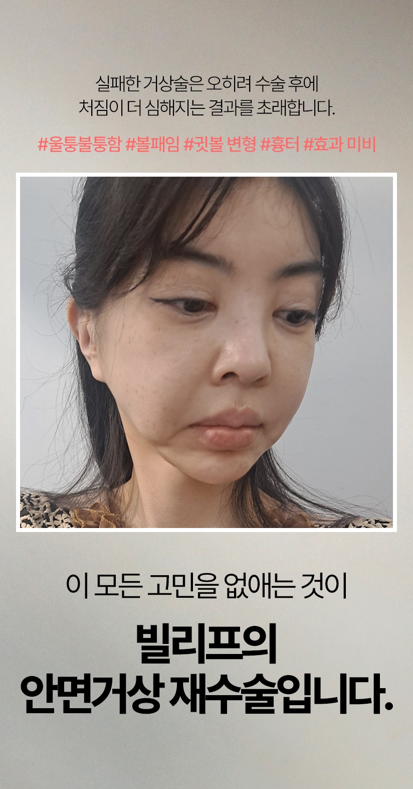 첫수술도 중요하지만, 재수술은 더 이상의 실패는 없어야 하기에 더욱 신중하게 수술 진단부터 집도, 후케어까지 신중에 신중을 더하여 책임 진료합니다. 실패한 거상술은 오히려 수술 후에 더 처짐이 심해지는 결과를 초래합니다. 울퉁불퉁함 볼패임 귓볼 변형 흉터 효과 미비 ..우리는 이 모든 고민을 없애는 것이 안면거상 재수술의 정석입니다.