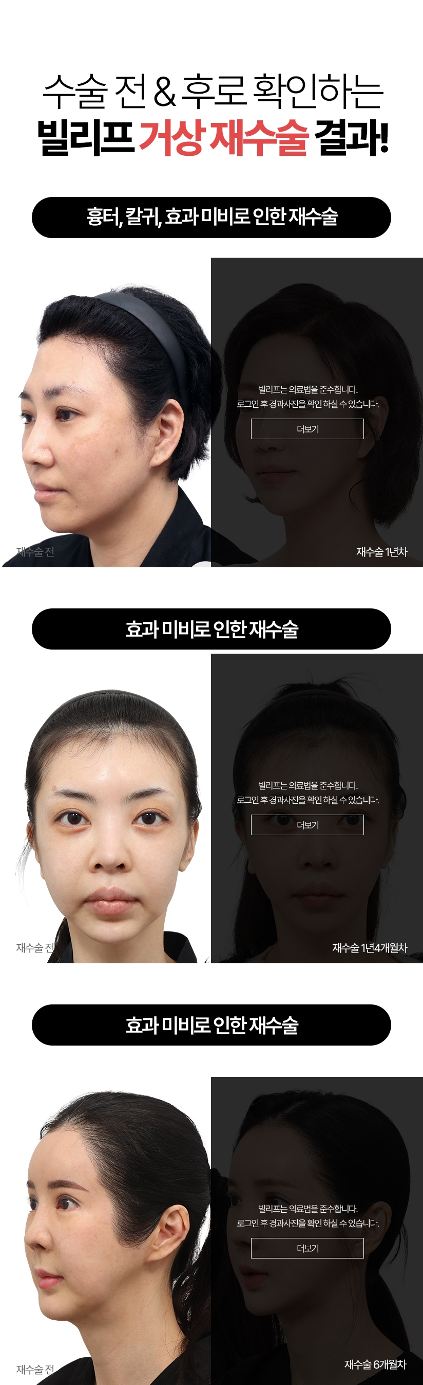 수술 전&후로 확인하는 빌리프 거상 재수술 결과! 흉터, 칼귀, 효과 미비로 인한 재수술 효과 미비로 인한 재수술 효과 미비로 인한 재수술