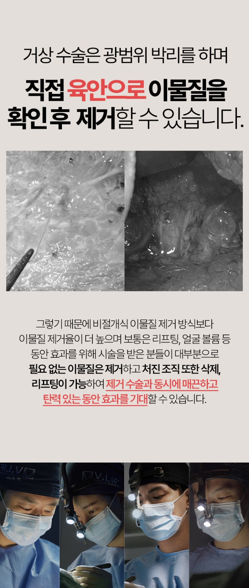 거상 수술은 광범위 박리를 하며 직접 육안으로 이물질을 확인 후  제거할 수 있기 때문에 비절개식 이물질 제거 방식보다 이물질 제거율이 더 높으며 보통은 리프팅, 얼굴 볼륨을 등  동안 효과를 위해 시술을 받은 분들이 대부분으로필요 없는 이물질은 제거하고 처진 조직 또한 삭제, 리프팅이 가능하여  제거 수술과 동시에 매끈하고 탄력 있는 동안 효과를 기대할 수 있습니다. 