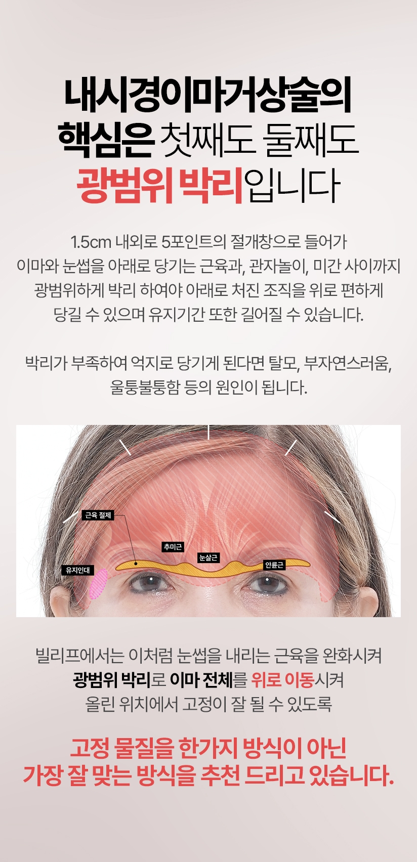내시경이마거상술의 핵심은 첫째도 둘째도 광범위 박리입니다 1.5cm 내외로 5포인트의 절개창으로 들어가 이마와 눈썹을 아래로 당기는 근육과, 관자놀이, 미간 사이까지 광범위하게 박리 하여야 아래로 처진 조직을 위로 편하게 당길 수 있으며 유지기간 또한 길어질 수 있습니다. 박리가 부족하여 억지로 당기게 된다면 탈모, 부자연스러움, 울퉁불퉁함 등의 원인이 됩니다. 빌리프에서는 이처럼 눈썹을 내리는 근육을 완화시켜 광범위 박리로 이마 전체를 위로 이동시켜 올린 위치에서 고정이 잘 될 수 있도록 고정 물질을 한가지 방식이 아닌 가장 잘 맞는 방식을 추천 드리고 있습니다.