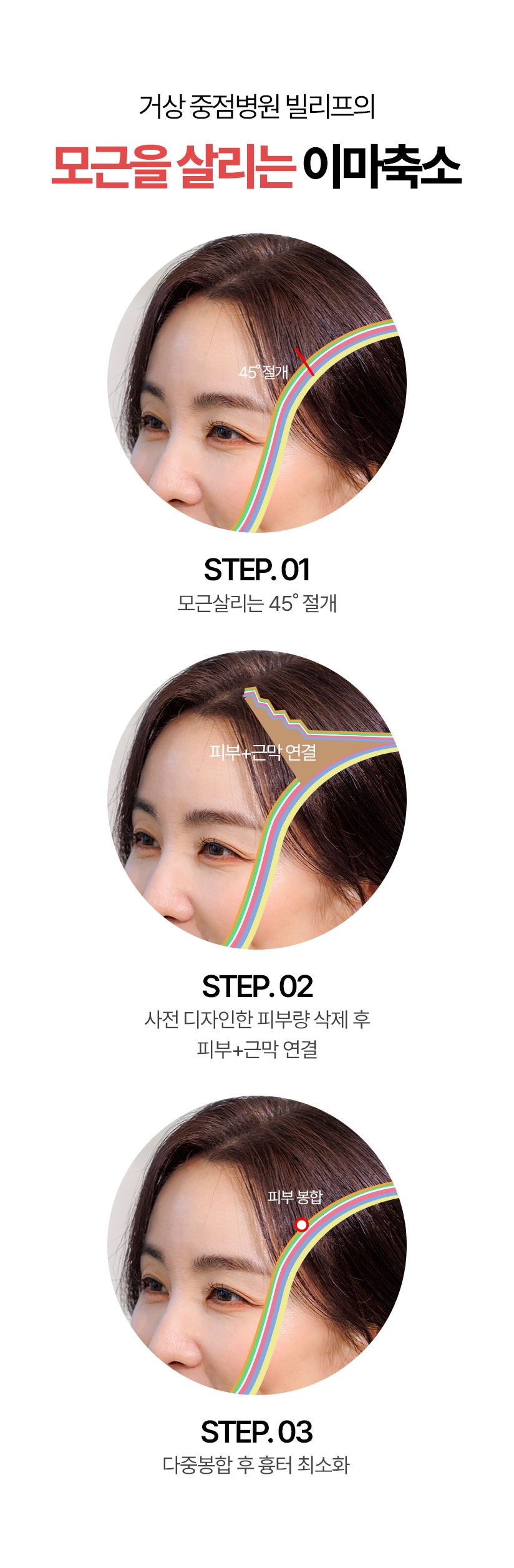 거상 중점병원 빌리프의 모근을 살리는 이마축소 STEP.01 - 모근살리는 45도 절개, STEP-02 - 사전 디자인한 피부랑 삭제 후 피부+근막 연결, STEP.03 - 다중봉합 후 흉터 최소화
