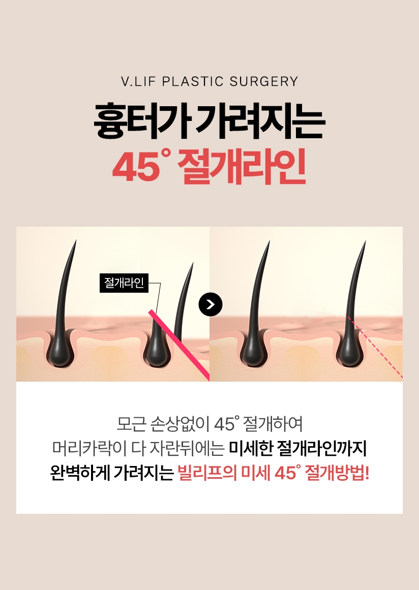 흉터가 가려지는 45˚ 절개라인 모근 손상없이 45˚ 절개하여 머리카락이 다 자란뒤에는 미세한 절개라인까지 완벽하게 가려지는 빌리프의 미세 45˚ 절개방법!