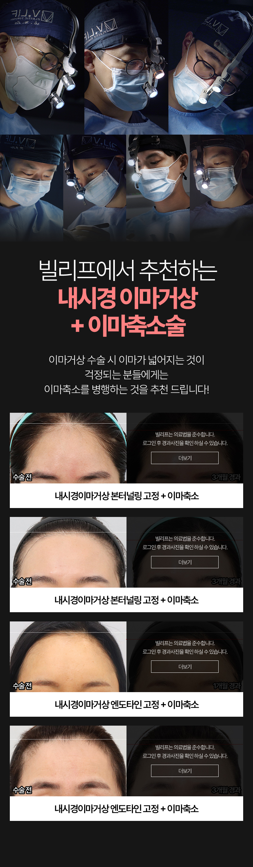 빌리프에서 추천하는 내시경 이마거상 + 이마축소술 이마거상 수술 시 이마가 넓어지는 것이 걱정되는 분들에게는 이마축소를 병행하는 것을 추천 드립니다! 수술전 3개월경과 - 내시경이마거상 본터널링 고정 + 이마축소, 수술전 3개월 경과 - 내시경이마거상 본터널링 고정 + 이마축소