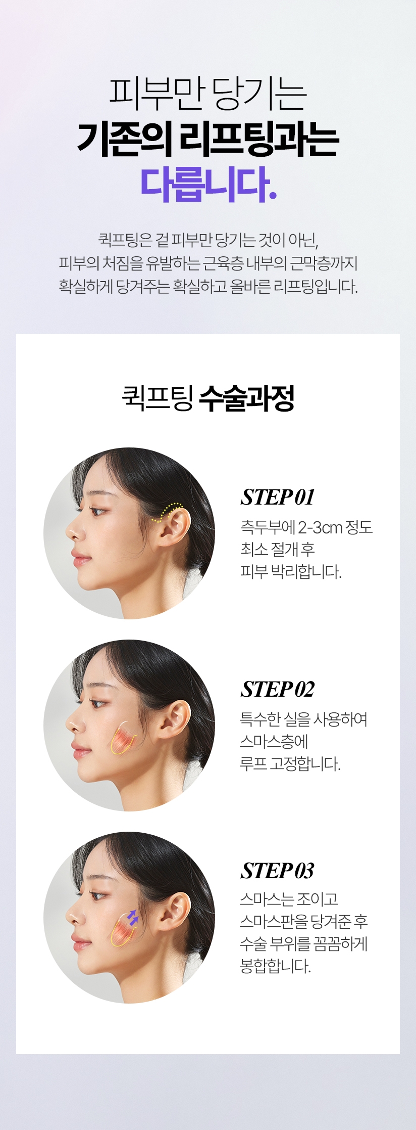 피부만 당기는 기존의 리프팅과는 다릅니다. 퀵프팅은 겉 피부만 당기는 것이 아닌, 피부의 처짐을 유발하는 근육층 내부의 근막층까지 확실하게 당겨주는 확실하고 올바른 리프팅입니다.-퀵프팅 수술과정 STEP 1. 측두부에 2-3cm 정도 최소 절개 후 피부 박리합니다. STEP 2. 특수한 실을 사용하여 스마스층에 루프 고정합니다. STEP 3. 스마스를 조여주고 스마스판을 당겨주고 수술 부위를 꼼꼼하게 봉합합니다.