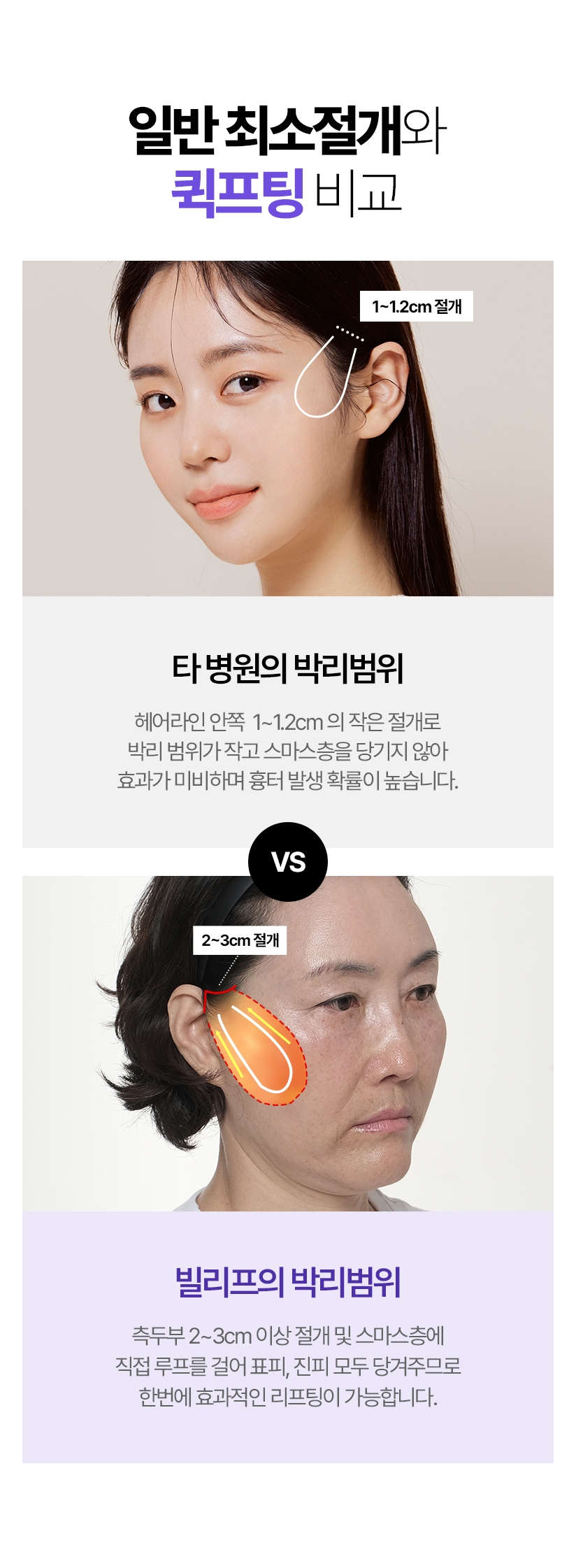 일반 최소절개와 퀵프팅 비교 타 병원의 박리범위 - 헤어라인 안쪽  1~1.2CM 의 작은 절개로 박리 범위가 작고 스마스층을 당기지 않아 효과가 미비하며 흉터 발생 확률이 높습니다. 빌리프의 박리범위 측두부 2~3cm 이상 절개 및 스마스층에 직접 루프를 걸어 표피, 진피 모두 당겨주므로 한번에 효과적인 리프팅이 가능합니다. 