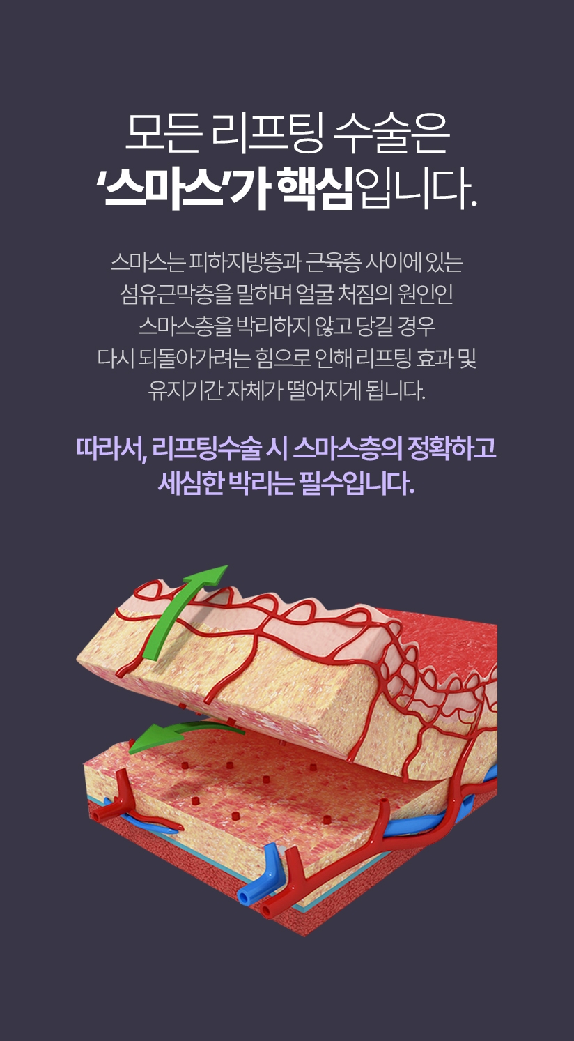 모든 리프팅 수술은 ‘스마스’가 핵심입니다. 스마스는 피하지방층과 근육층 사이에 있는 섬유근막층을 말하며 얼굴 처짐의 원인인 스마스층을 박리하지 않고 당길 경우 다시 되돌아가려는 힘으로 인해 리프팅 효과 및 유지기간 자체가 떨어지게 됩니다. 따라서, 리프팅수술 시 스마스층의 정확하고 세심한 박리는 필수입니다.