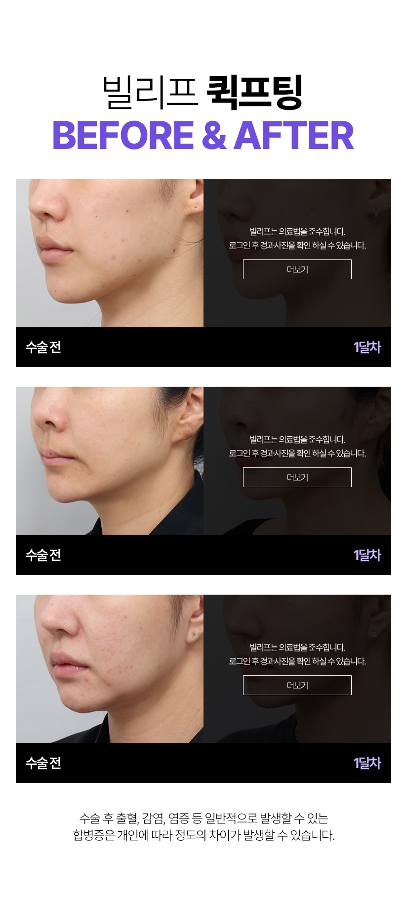 빌리프 퀵프팅 Before & After 수술전 - 1달차